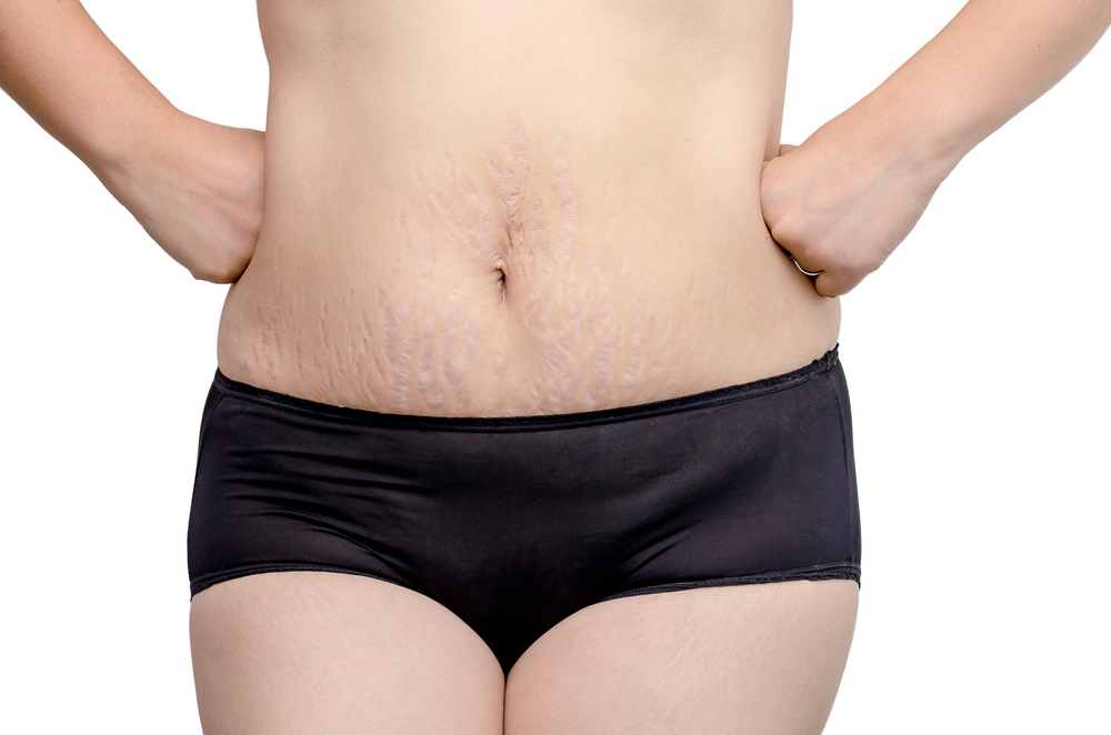 Stretch Marks Treatment Toronto